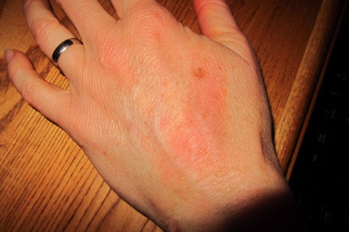 A few days after my wife's hand was burned by boiling water